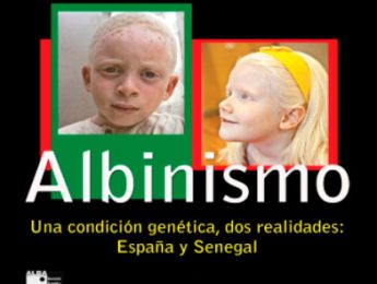 Imagen de la noticia Albinismo. Exposición