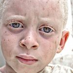 Imagen de la noticia Albinismo: exposición fotográfica y cortometraje